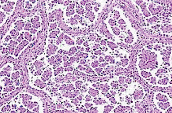 Imagen: La morfología microcapilar en un cáncer pulmonar (Fotografía cortesía del Centro de Cáncer Memorial Sloan-Kettering).